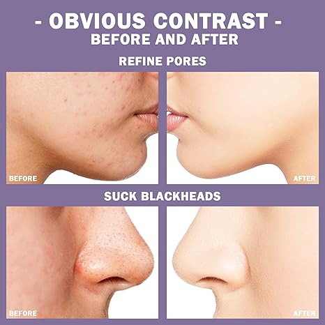 ROLLER FACIAL - MASCARILLA PUNTOS NEGROS